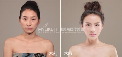 米穎 術(shù)前0&deg;.jpg