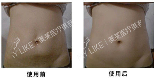 去妊娠紋.jpg