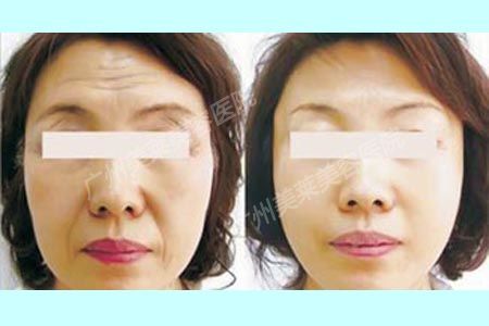 注射膠原蛋白的價格是多少?