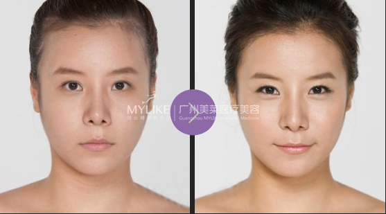 自體脂肪豐臉頰適合哪些人?