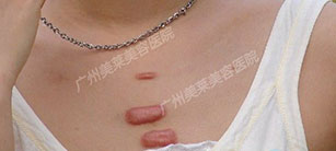 疤痕疙瘩的注意事項