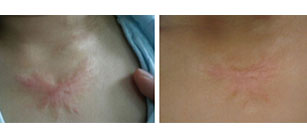 關于疤痕疙瘩，你懂的有多少