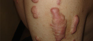 疤痕疙瘩癥狀是什么