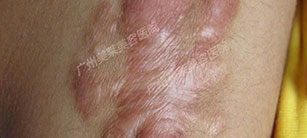 有疤痕疙瘩就是疤痕體質(zhì)嗎
