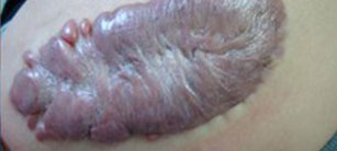 夏季炎熱疤痕容易惡變怎么辦