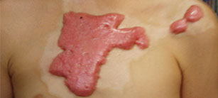 如何去除疤痕疙瘩防止復(fù)發(fā)