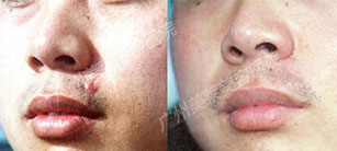 燙傷疤痕疙瘩不治療危害大