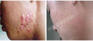疤痕疙瘩痛癢難忍，關(guān)鍵選好祛疤方法