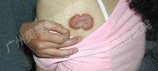 疤痕疙瘩危害大，美萊隱形祛疤修復(fù)術(shù)治療效果好