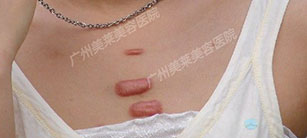 多少錢可以去除疤痕疙瘩