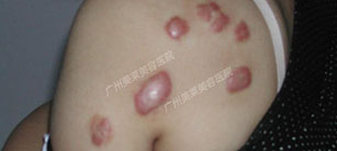 疤痕疙瘩針對(duì)治療效果好