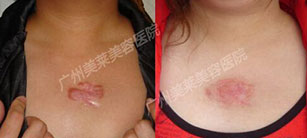 疤痕疙瘩治療好的辦法