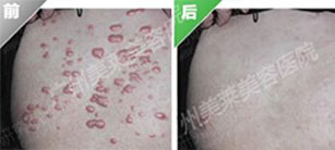 疤痕疙瘩如何治療，怎么去除瘢痕疙瘩