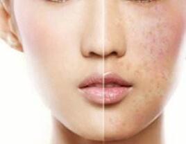 激光祛黃褐斑后還會(huì)再反彈嗎