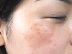 臉上長(zhǎng)斑怎么快速祛除