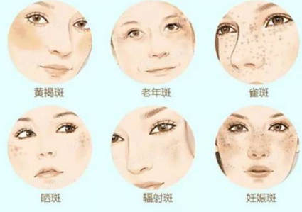 激光祛斑術(shù)后護(hù)理需要注意什么事項