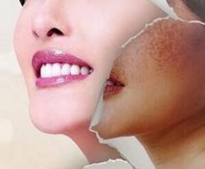 激光祛斑的恢復期有多長