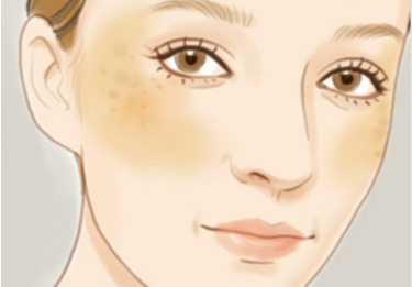 激光祛斑的效果還會反彈嗎