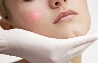 激光祛斑后的反黑期長(zhǎng)不長(zhǎng)