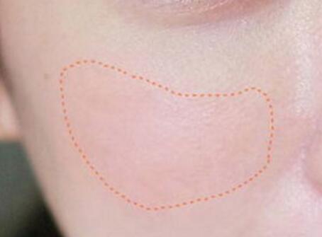 激光美容祛斑多少錢(qián)