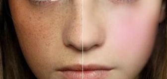 激光美容祛斑多少錢(qián)