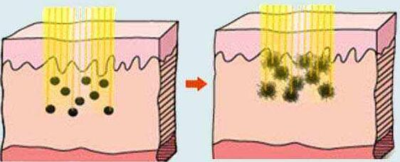激光祛斑需要留院觀察嗎