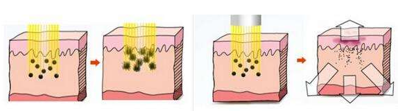 臉部做激光祛斑多少錢