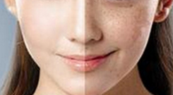 蜂巢皮秒祛斑會反彈嗎