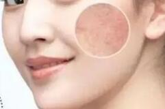 女人臉上長斑的原因及改善方法