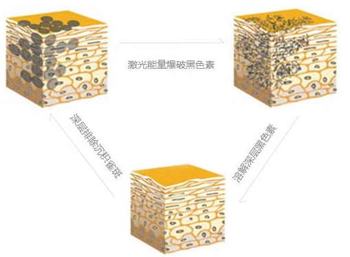 皮秒祛斑會(huì)有結(jié)痂嗎