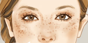 激光祛斑會不會留疤