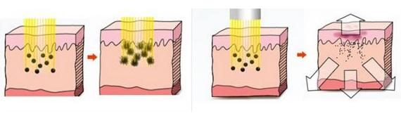 做激光祛斑的損傷大不大