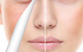 懷孕期間可以做激光祛黃褐斑嗎