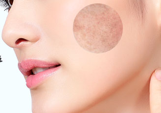 激光祛斑價格一般是多少