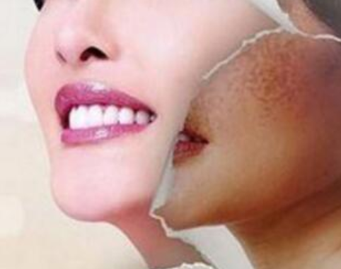 激光祛斑會有危害嗎