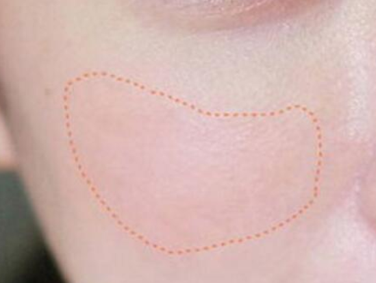 激光祛斑會有危害嗎