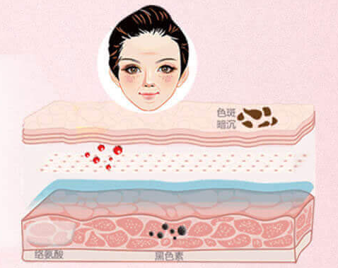 激光祛雀斑后還會反彈嗎