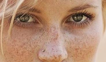 為什么臉部會有雀斑