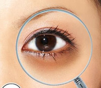 激光治療黑眼圈要多少錢