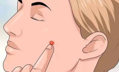 激光祛痘多久才會有效果呢