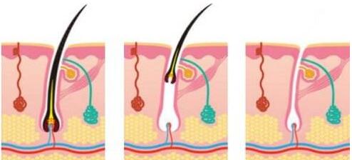 廣州激光脫毛一般多少錢