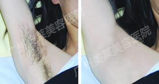激光脫腋毛要多久才能恢復呢