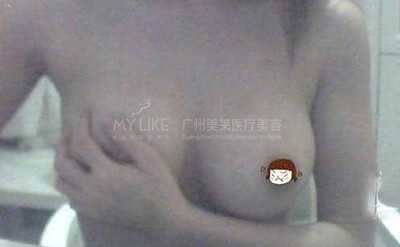 乳房下垂+乳頭整形3.jpg