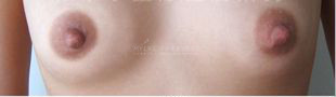 乳頭過大+乳暈過大-術(shù)前.jpg