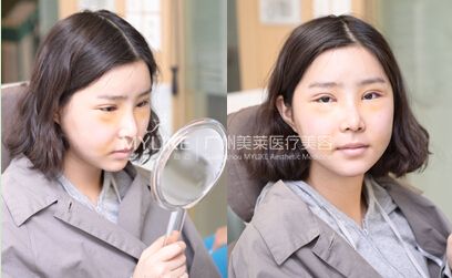 我的雙眼皮手術(shù)分享2.jpg