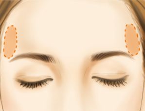 玻尿酸豐太陽穴安全嗎