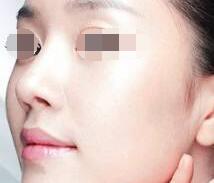 自體脂肪面部填充要多少錢