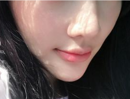 打完瘦臉針后要不要忌口