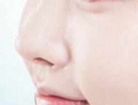 鼻翼縮小手術(shù)后會(huì)影響工作嗎