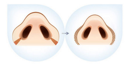 鼻翼縮小手術多久才能消腫